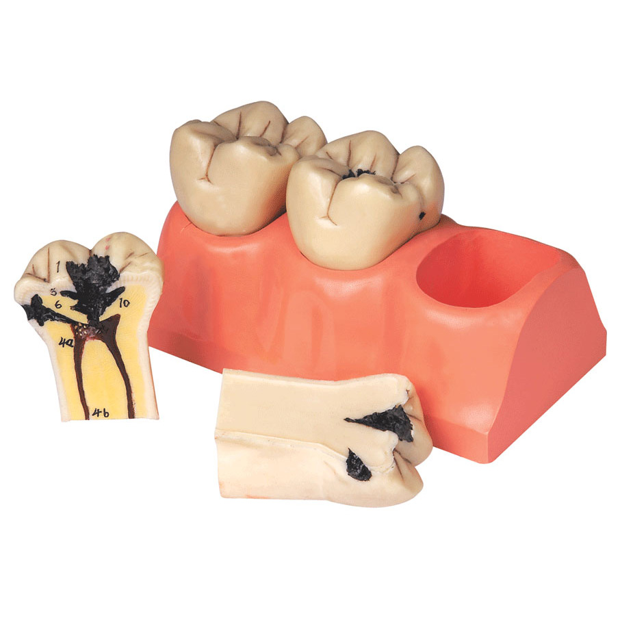 牙齒病變模型簡(jiǎn)述