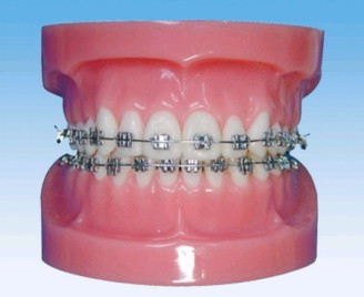 固定牙齒矯正模型（正常）