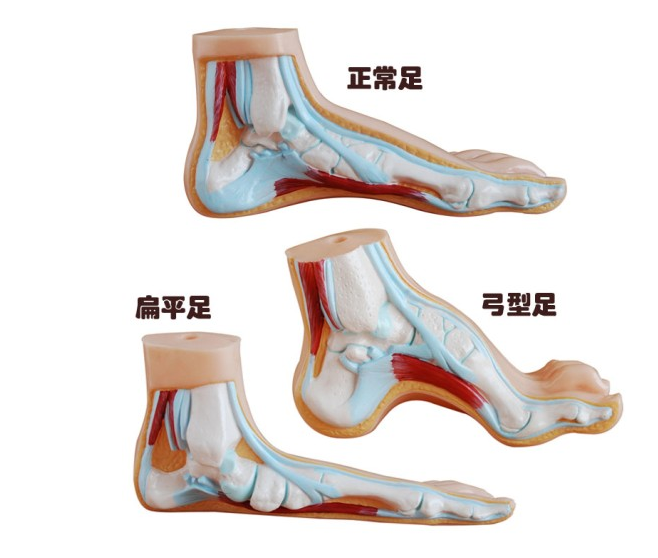 正常足(扁平足、弓型足)模型